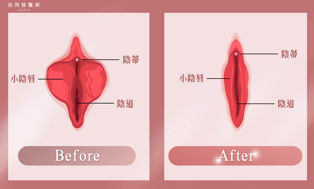 五合一生物束帶私密處緊縮術-小陰唇美型手術前後 | 佳飛雅醫美